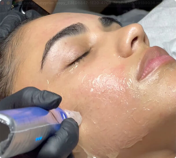 Intelligente Technologie ist das Markenzeichen von SkinPen®