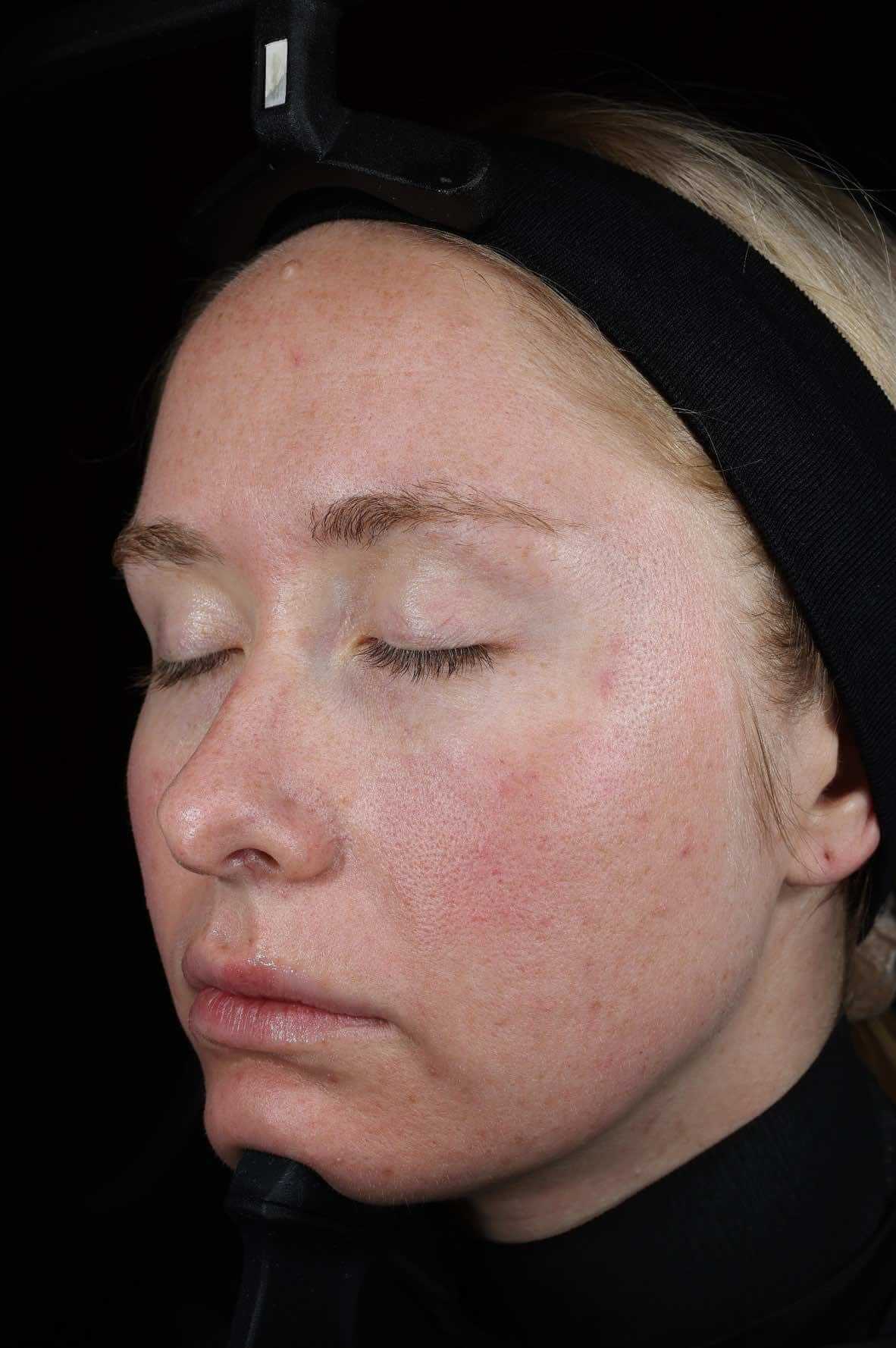 SkinPen treatment progress 24 Stunden