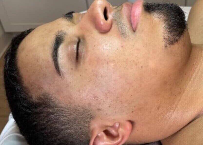 Nachher
